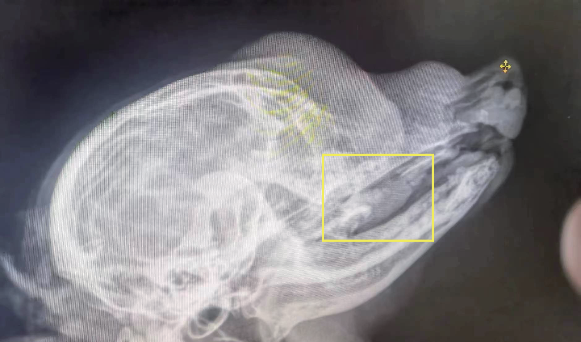 After RF Ablation
